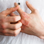 Psoriasis: orsak, symtom & behandling